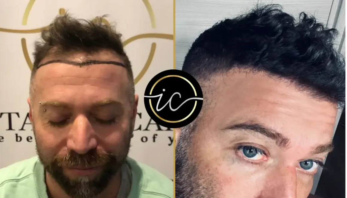 Ho Fatto il Trapianto di Capelli in Turchia: la Mia Esperienza